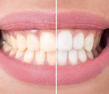 Why KöR deep bleaching is one of the best teeth whitening methods available at the dentist
