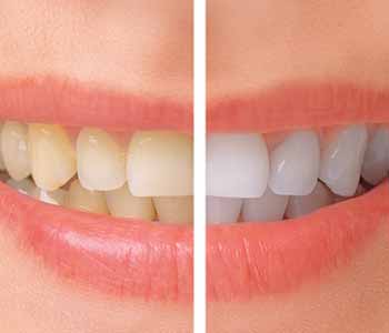 Why cosmetic Teeth Whitening is a popular procedure for patients in Philadelphia