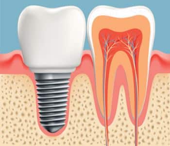 Dental Implant model image animation