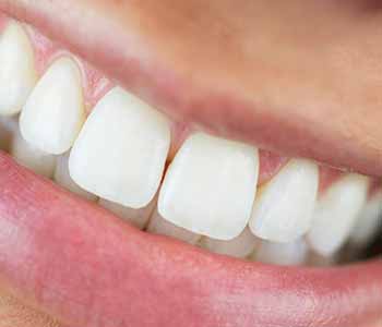 Philadelphia Dentist describes KöR Whitening