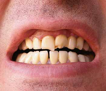 Dr. Anirudh Patel describes dental bonding for teeth