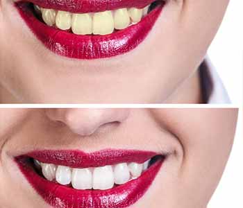 How professional Teeth Whitening works better than over-the-counter methods for Philadelphia area patients