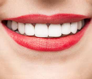 Why patients in Philadelphia choose professional-grade teeth whitening instead of over-the-counter solutions