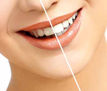 Why professional teeth whitening procedures are best for Philadelphia patients