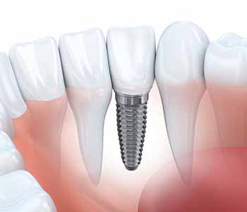 Dr. Spilkia, an exceptional implant dentist in Philadelphia, PA, about restoring your missing teeth today.