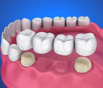 Crowns and bridges address damaged or missing teeth. Available from Innovative Dental in Philadelphia