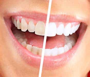 Types of Cosmetic Dental Services for Your Smile in Philadelphia, PA area
