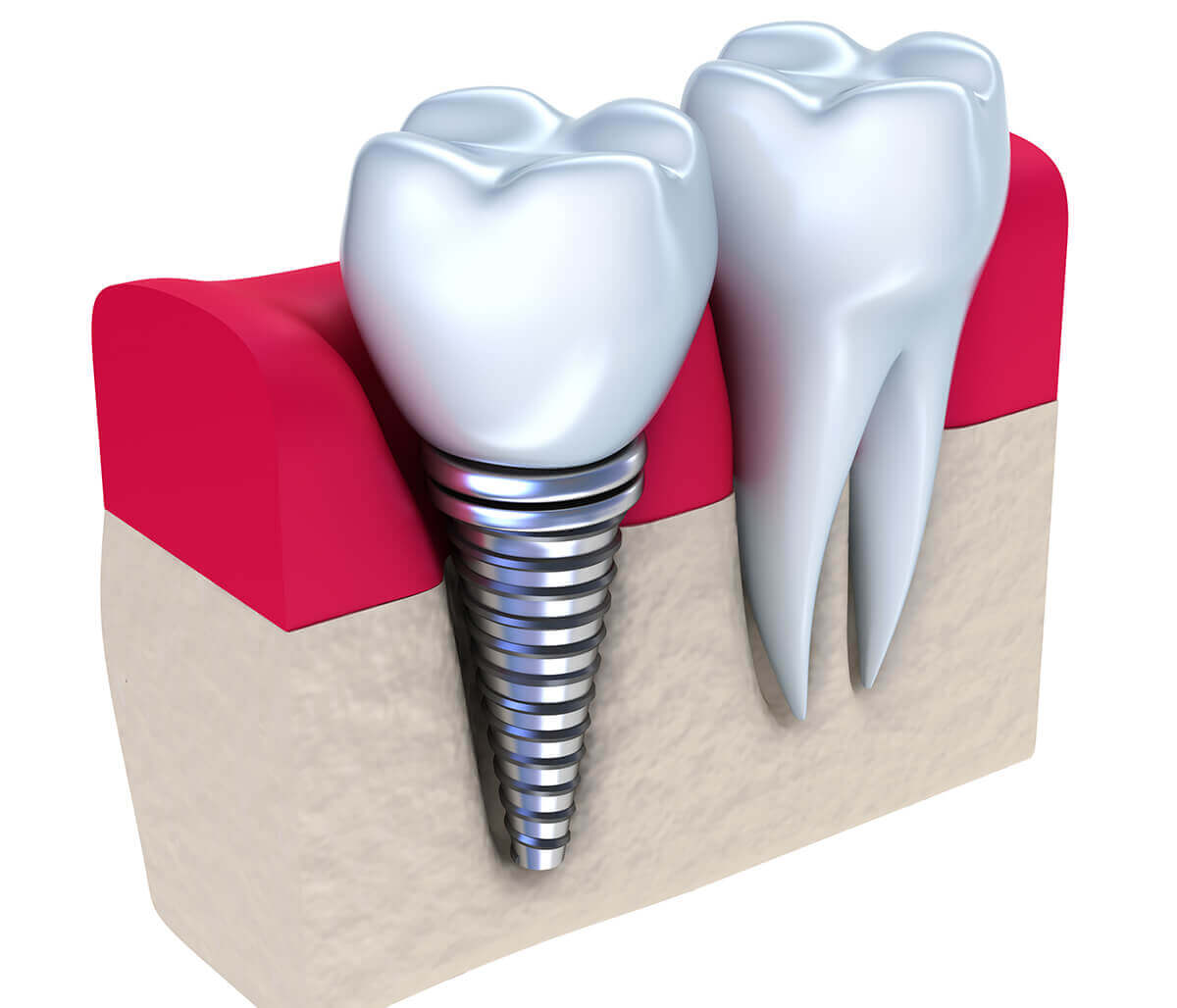 Dental Implants Vs Dentures at Innovative Dental in Philadelphia Area