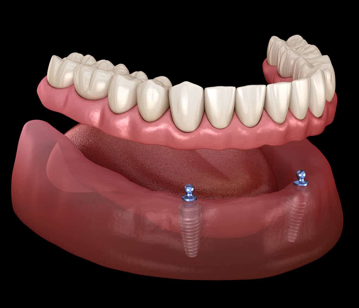Implant Supported Dentures at Innovative Dental in Philadelphia Area