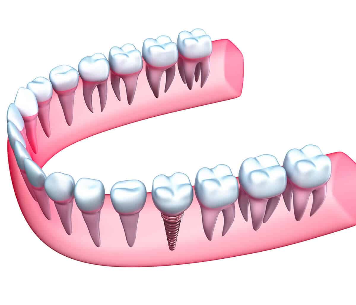 Implants for Teeth at Innovative Dental in Philadelphia Area