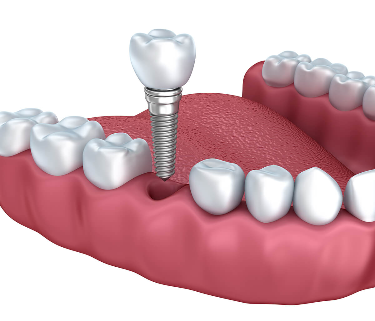 Dental Implant Recovery Diet in Philadelphia PA Area