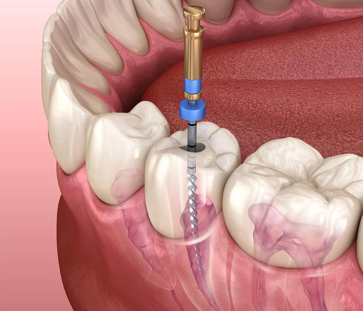 Root Canal Treatment in Philadelphia PA Area
